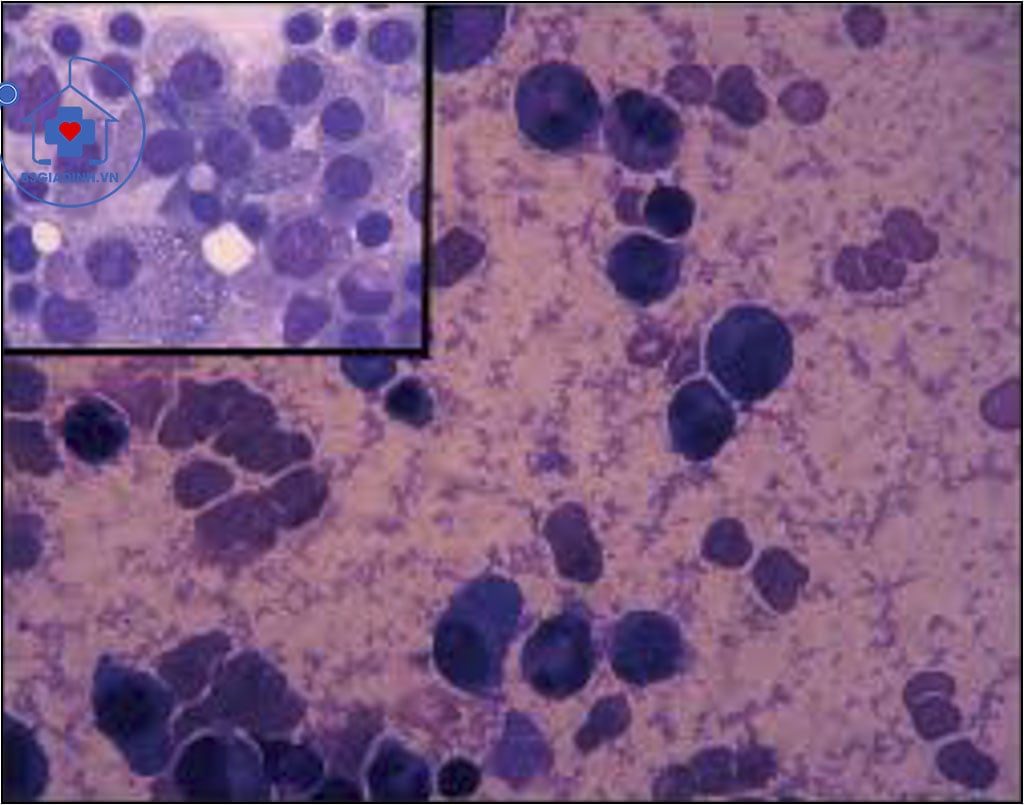 xét nghiệm Cryoglobulin