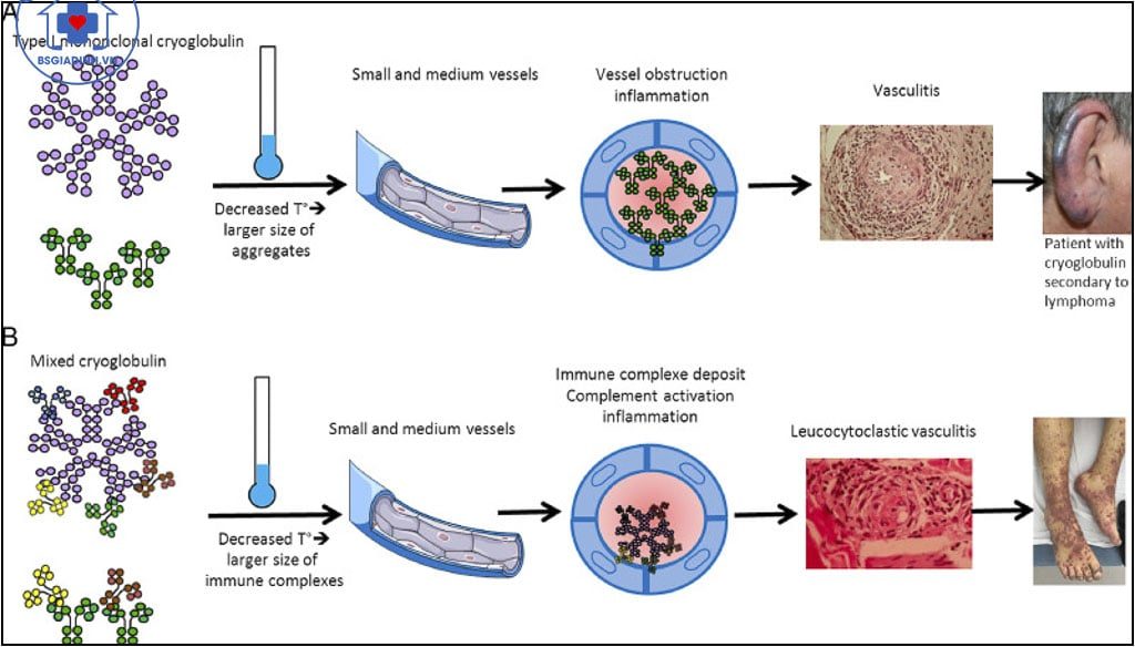 xét nghiệm Cryoglobulin