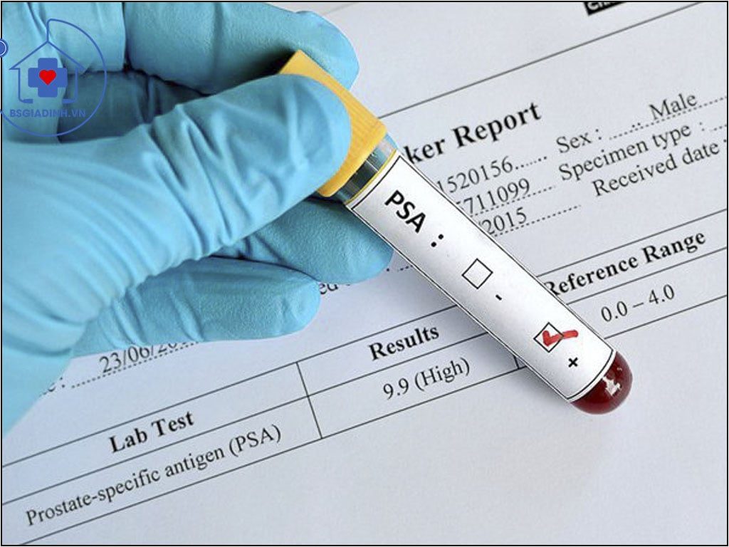 xét nghiệm PSA