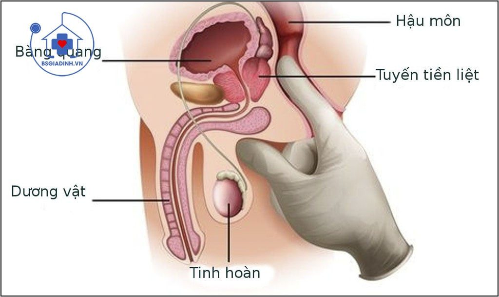 PSA tuyến tiền liệt