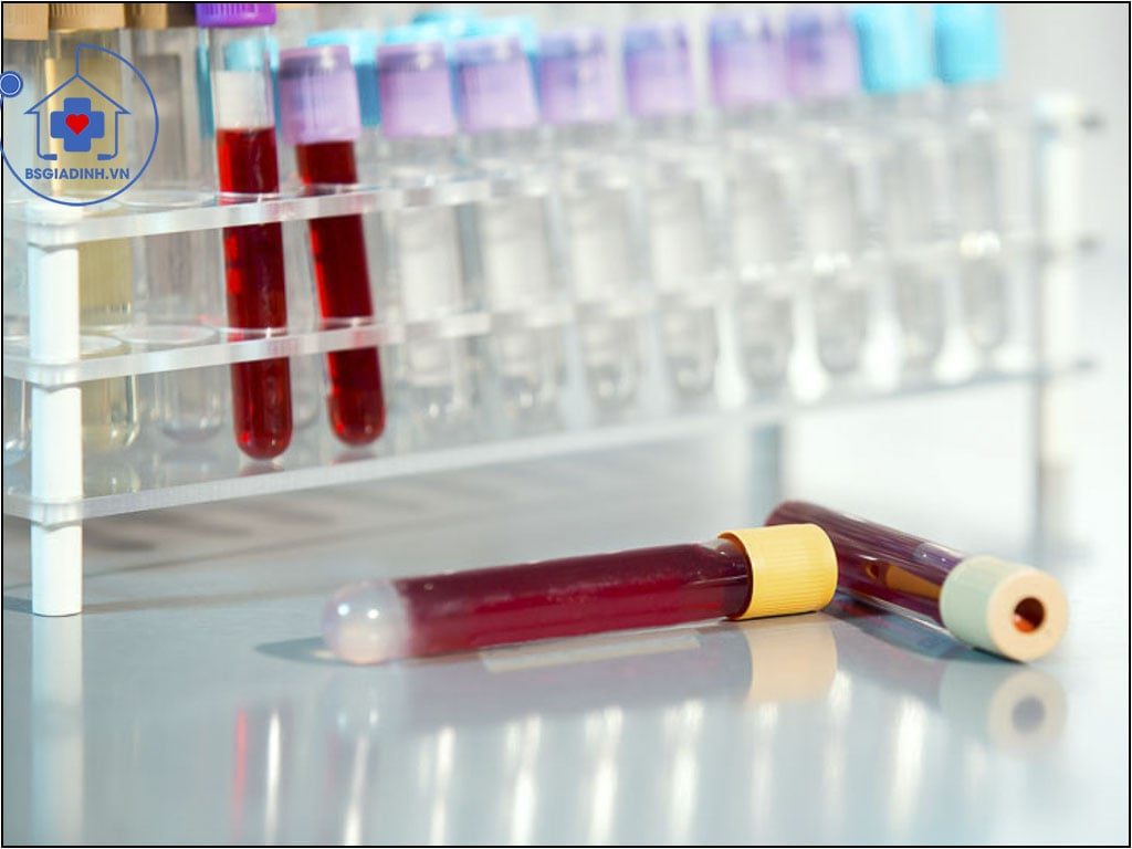 xét nghiệm bổ thể