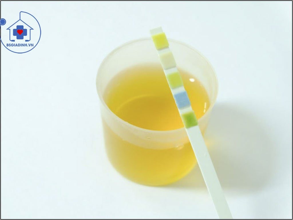 xét nghiệm canxi niệu