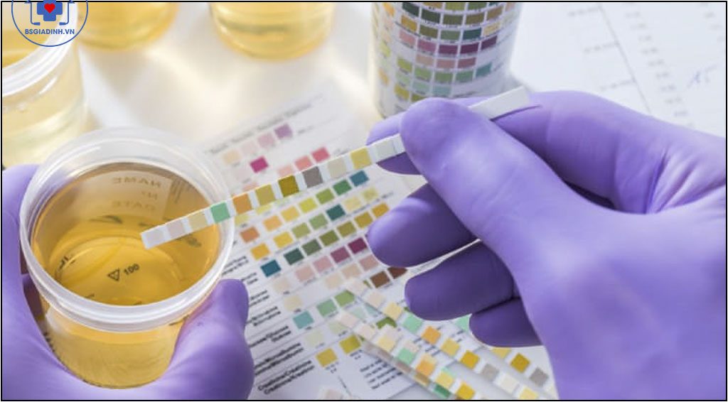xét nghiệm glucose niệu