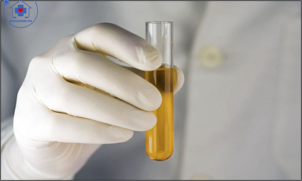 xét nghiệm glucose niệu