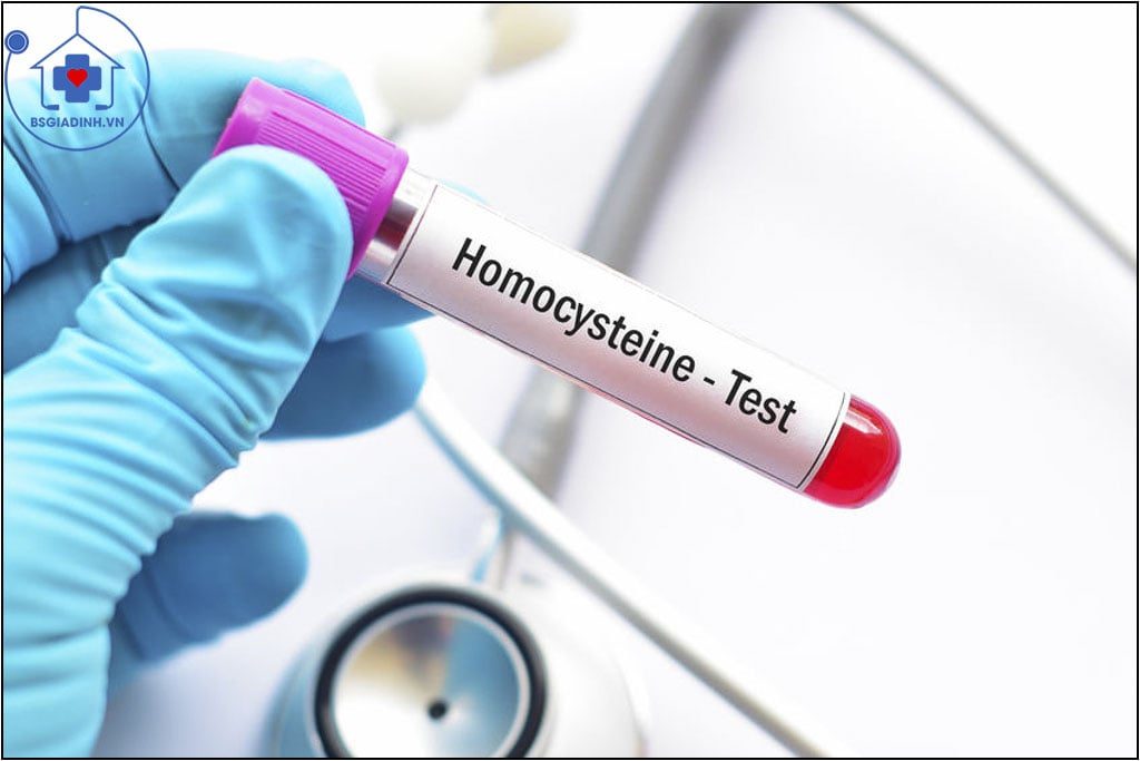 Homocysteine là gì? Khi nào cần làm xét nghiệm Homocysteine?