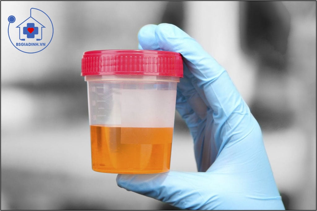 xét nghiệm kali trong nước tiểu