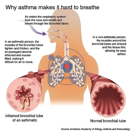 triệu chứng khó thở của hệ tim mạch